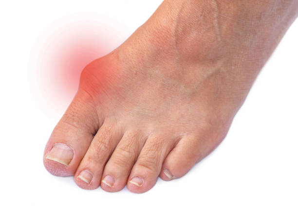 Kingsford Foot Clinic Bunions Bunionettes